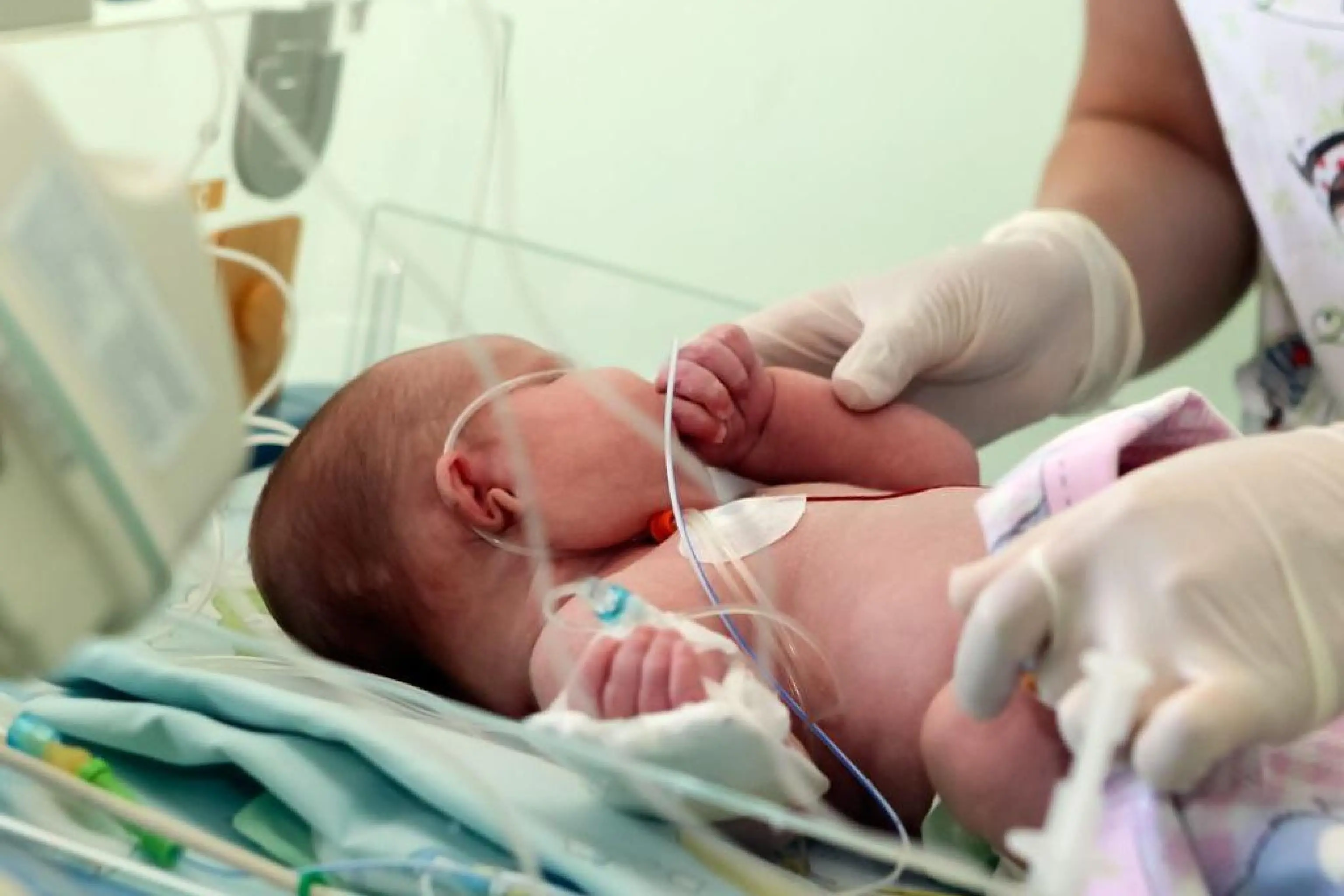 Virus sinciziale, con profilassi preventiva -84% ricoveri, -82% accessi in pronto soccorso