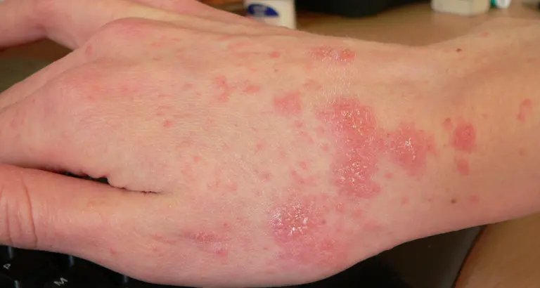 Scabbia negli asili e nelle scuole di Bolzano