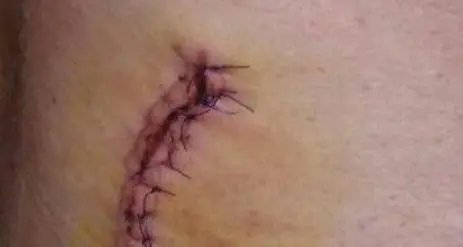Incidente a Cortaccia Parla l’operaio ferito «La colpa non è mia»