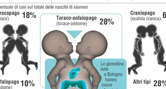 Roma, separate gemelle siamesi algerine