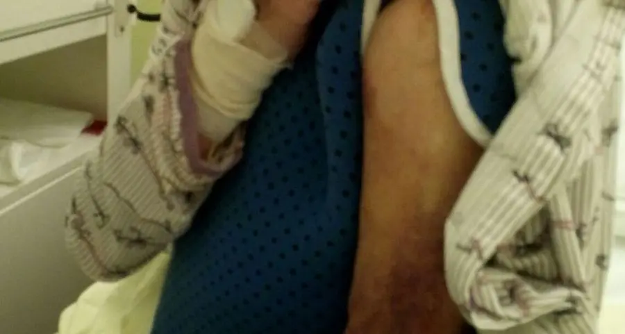 Cade dal Citybus e si fa 1 mese di ospedale