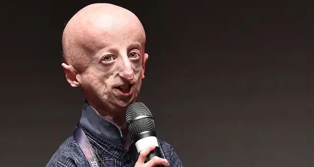 Sammy Basso, operato il cuore invecchiato precocemente