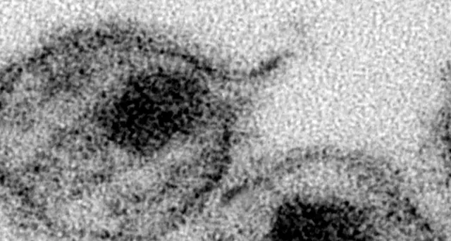 Curato a Londra secondo paziente con Hiv