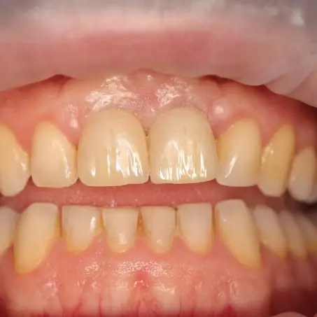 Ricostruzione naturale dell’osso dentale