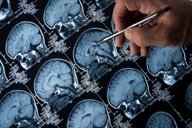 Alzheimer, il Centro Tutela Diritti del Malato: «Assegno di cura, servono criteri equi e trasparenti»