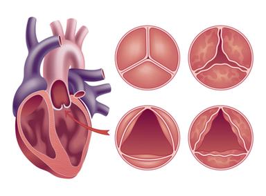 Un catetere per sostituire la valvola invece dell'intervento a cuore aperto