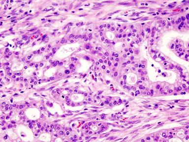 Le cellule del tumore del pancreas si travestono per sfuggire ai farmaci