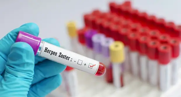 Fuoco di Sant’Antonio, uno su 4 a rischio di ammalarsi. L’Istituto di medicina generale: «Vaccinatevi»