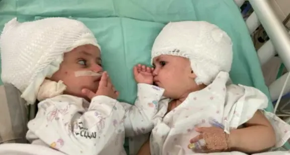 Le due gemelline si guardano: erano nate unite per la testa, ora sono separate