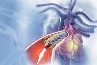 Angioplastica, placche di calcio presenti nel 30% dei pazienti