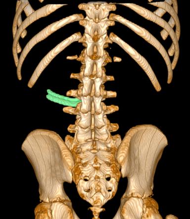### CANCELLATA: Leva del freno nella schiena per 3 anni, scoperta da radiografia e rimossa (2) ###