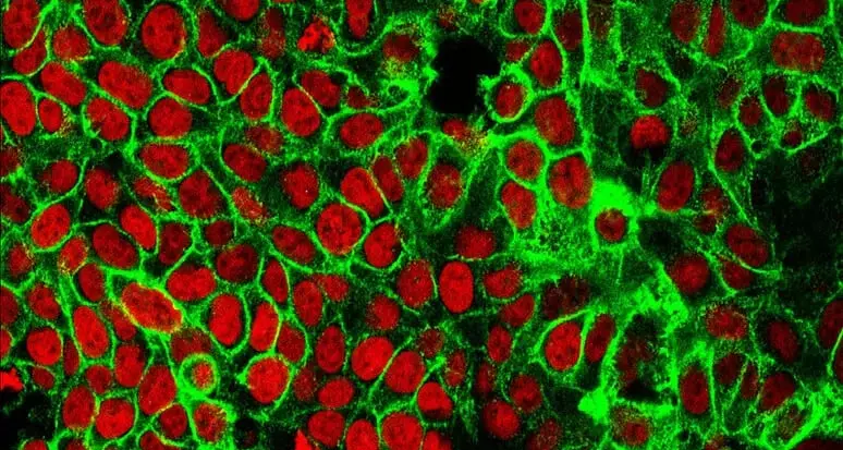 Scoperto il motore che rende i tumori aggressivi, il primo è quello al pancreas