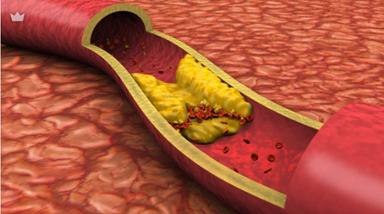 Arterosclerosi, con molecola innovativa riduzione maggiore del colesterolo 'cattivo'
