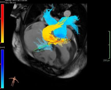 Per il cuore 230mila morti l'anno, un anno senza fumo dimezza rischi