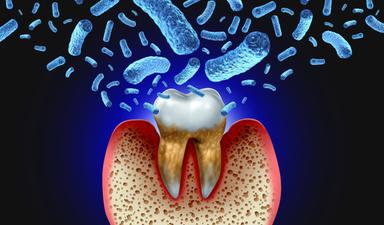Sviluppata una terapia mirata per la parodontite basata sulla luce