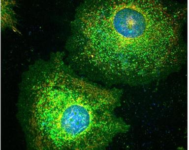 Le cellule tumorali diventano zombie per sfuggire alla chemioterapia