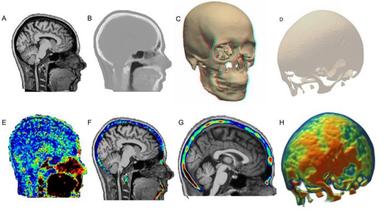 Dolore cronico da schiena a ginocchia, coinvolto il midollo osseo del cranio