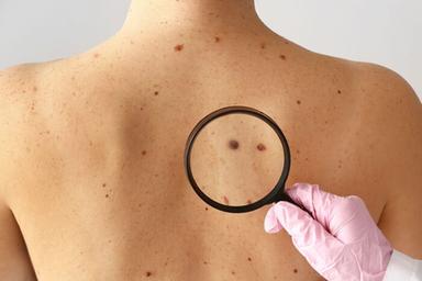 Melanoma, primo vaccino 'su misura' riduce il rischio di recidiva del 42%