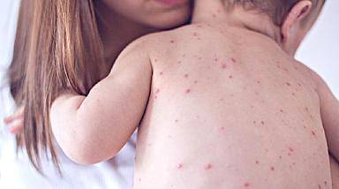 Aumentano i casi di morbillo, 'più vigilanza e vaccinazioni'