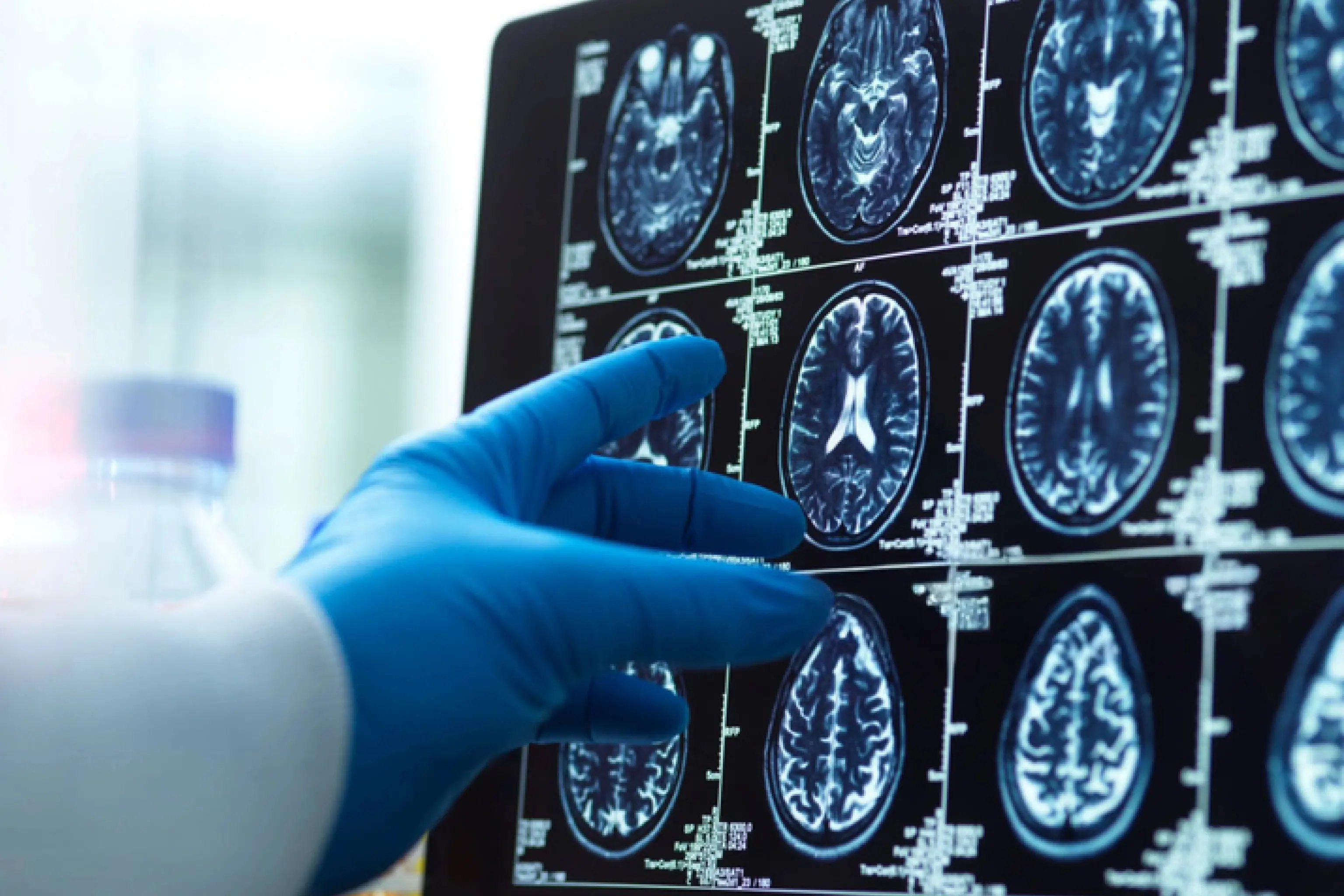 In Gb prima operazione per rimuovere tumore al cervello con l'aiuto dell'IA